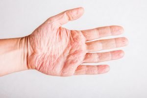 eczema atopic dermatitis s